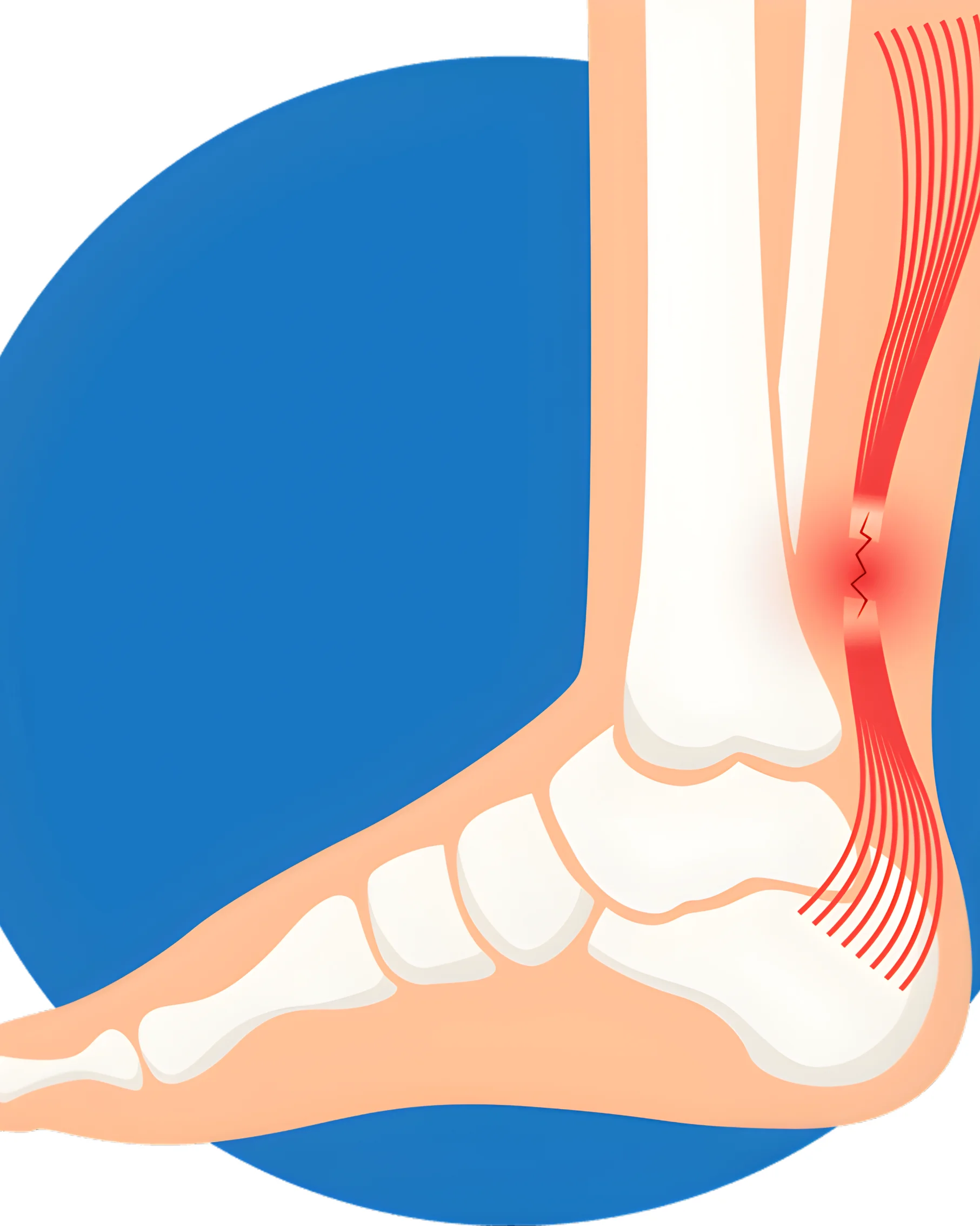 Dr Divya Bandari -  Achilles Tendon Injury Specialist